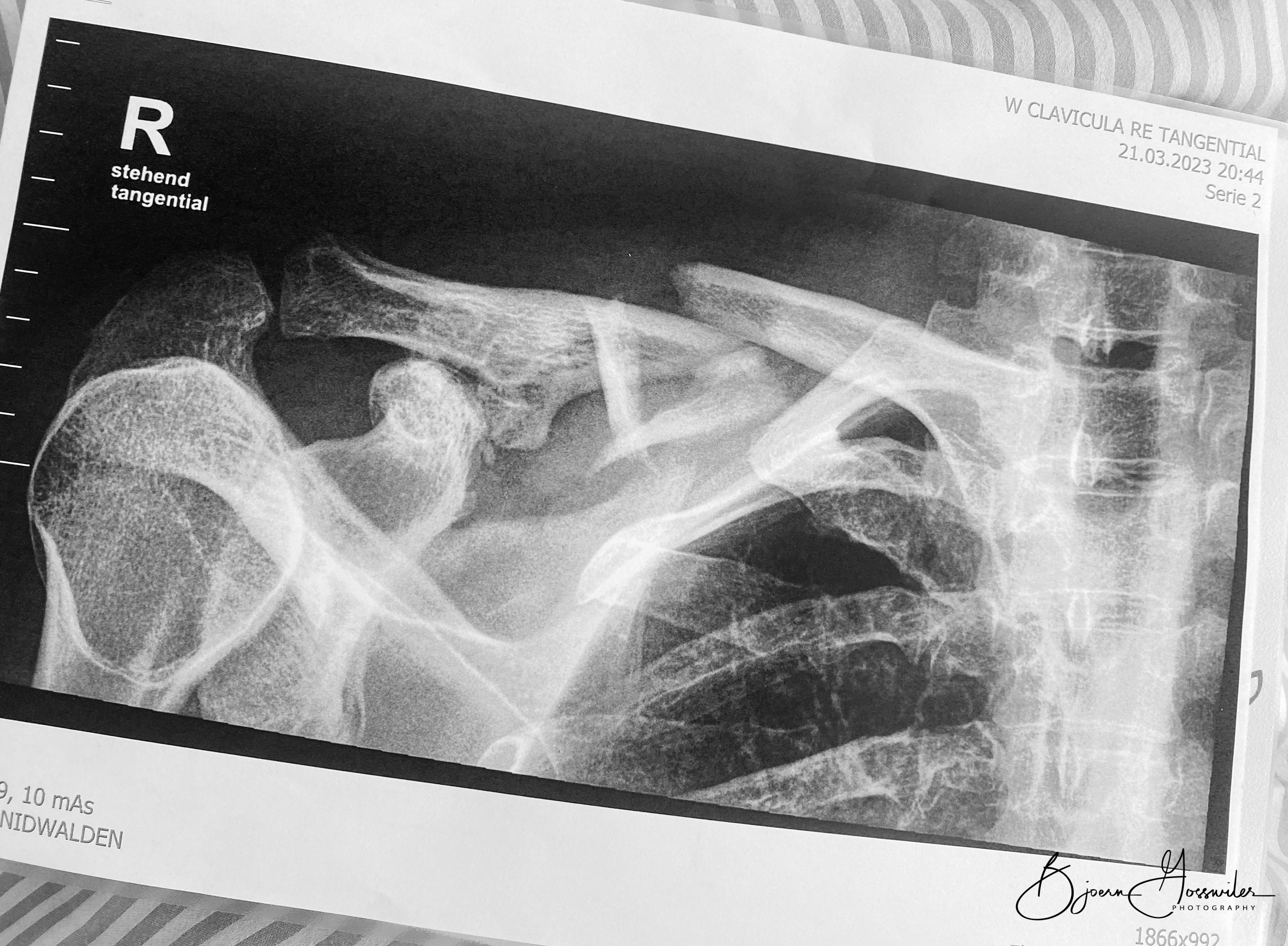 Schlüsslbeinbruch Röntgen